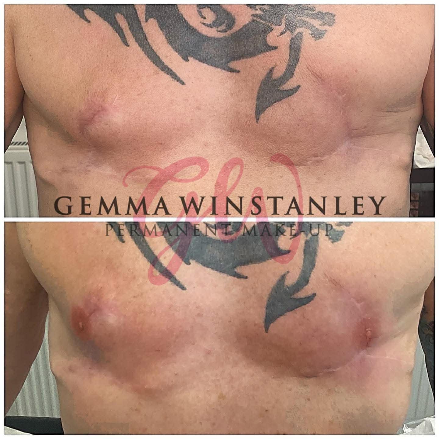 Before and after images showing the chest after permanent makeup tattooing by Gemma Winstanley, with visible scars and healed tattooed eyebrows.
