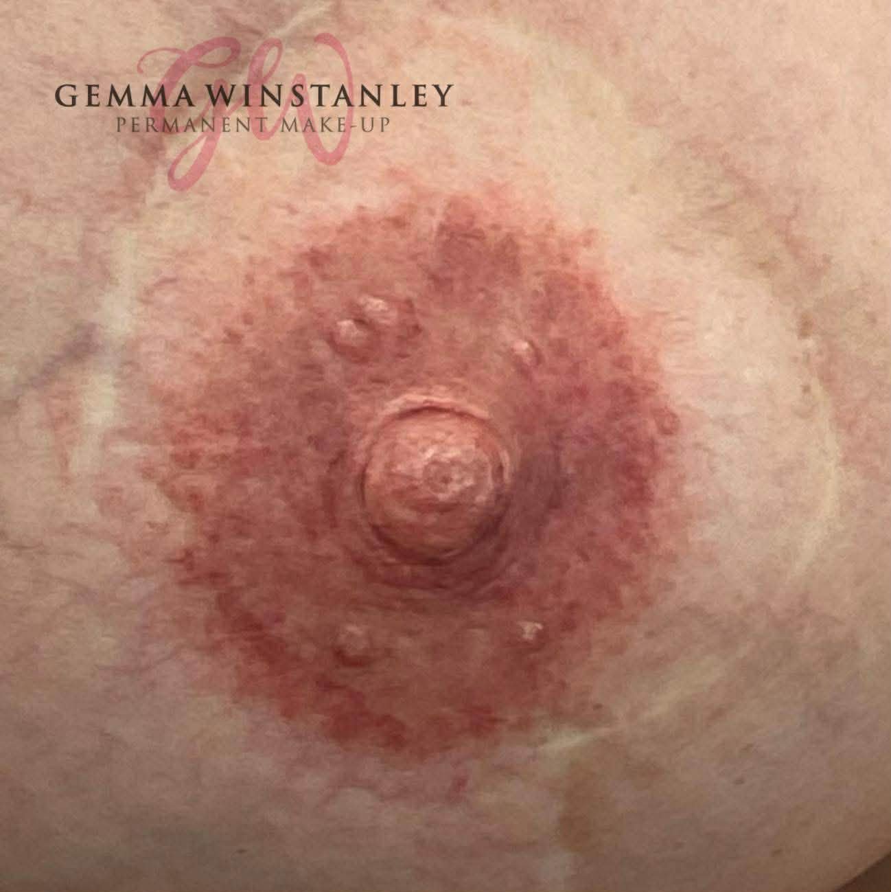 A close-up of a person's nipple with redness and irritation, with some small bumps and a piercing.