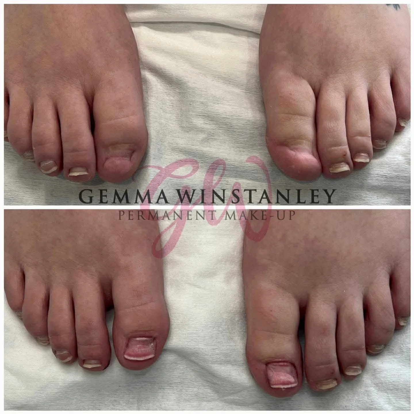 Before and after images of toenail correction, showing improved nail appearance after permanent make-up treatment.