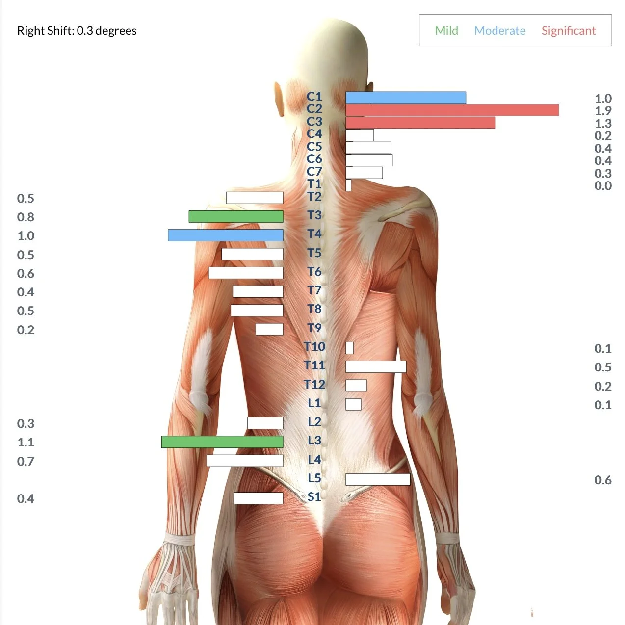 Chart depicting muscular pain levels in the back and shoulder muscles, with color-coded severity: green for mild, blue for moderate, and red for significant, alongside a human anatomical illustration of the back muscles.