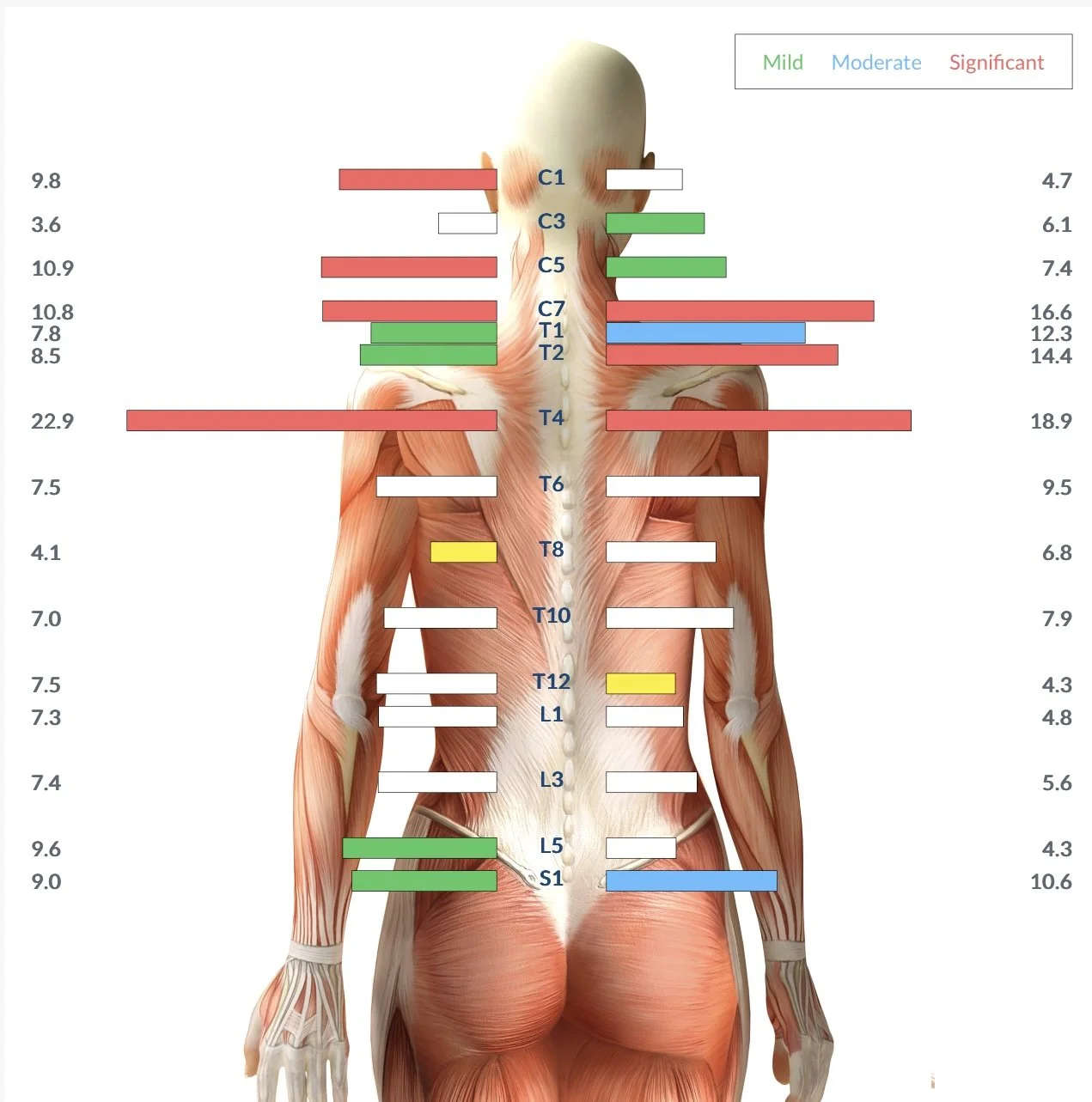 Medical chart showing pain severity levels at different points along the back and neck, with color coding for mild, moderate, and significant pain.