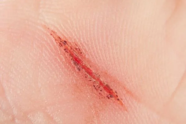 granulation-tissue-tissue-healing-in-yoga