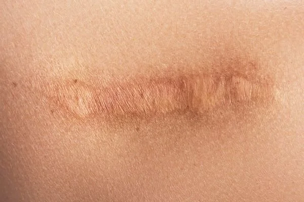 scar-tissue-tissue-healing-in-yoga