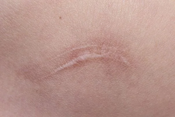 healed-scar-tissue-in-remodeling-phase-how-yoga-helps-with-healing