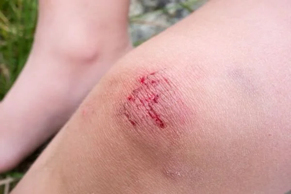 a-scraped-knee-for-the-phases-of-healing-tissue-in-yog