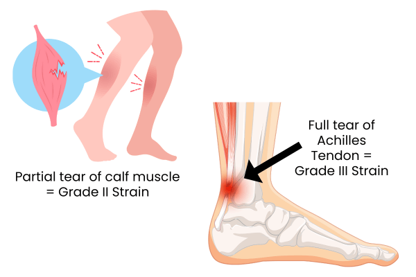 grade-ii-and-iii-strain-illustrations