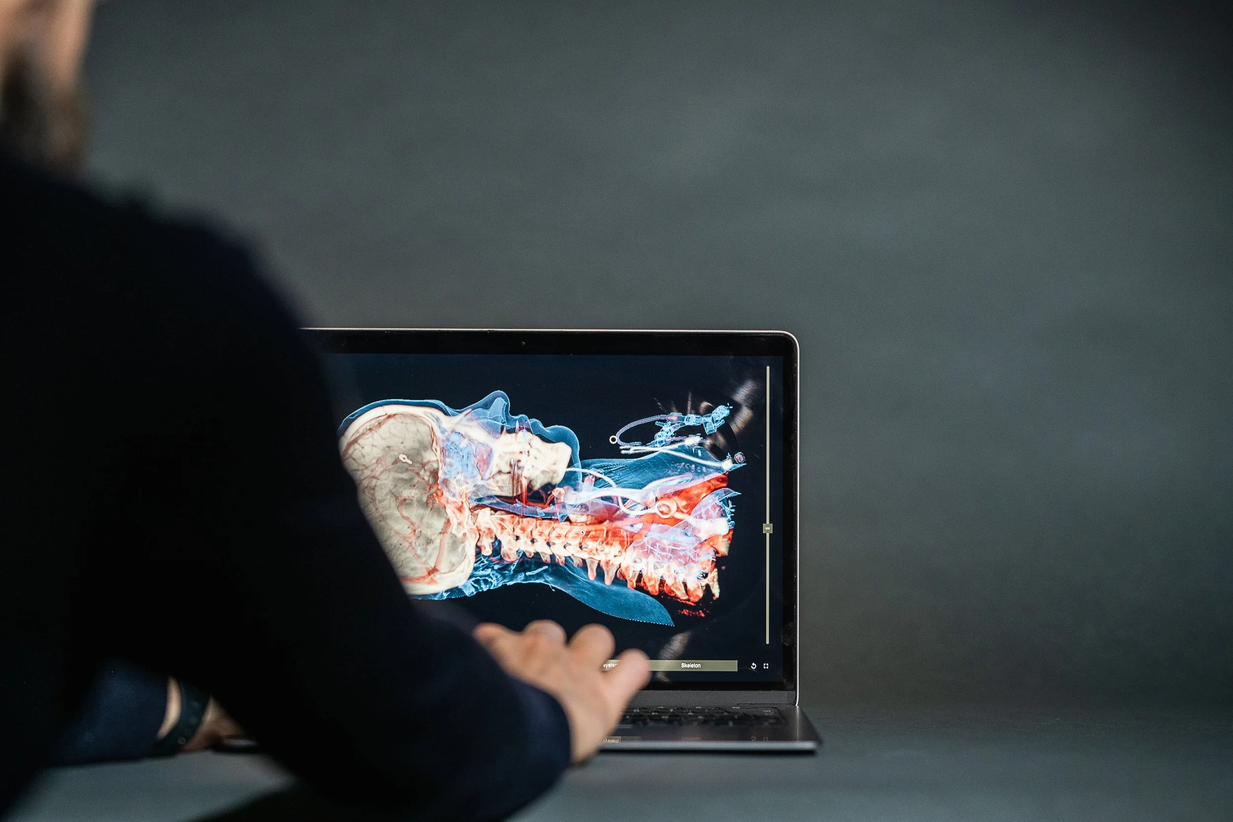 Person holding a laptop displaying a digital illustration of a human skull and internal anatomy against a plain background.