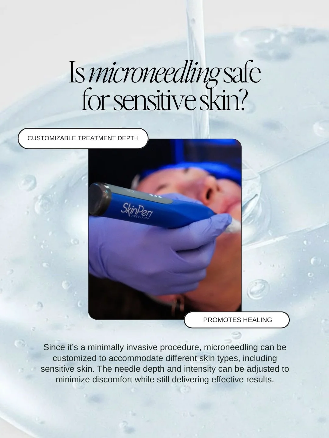 If you have been on the fence about microneedling because of sensitive skin, this one is for you. 🤍

These photos show the difference in our client from immediately after her microneedling session to 24 hours later. She has fair, sensitive skin that