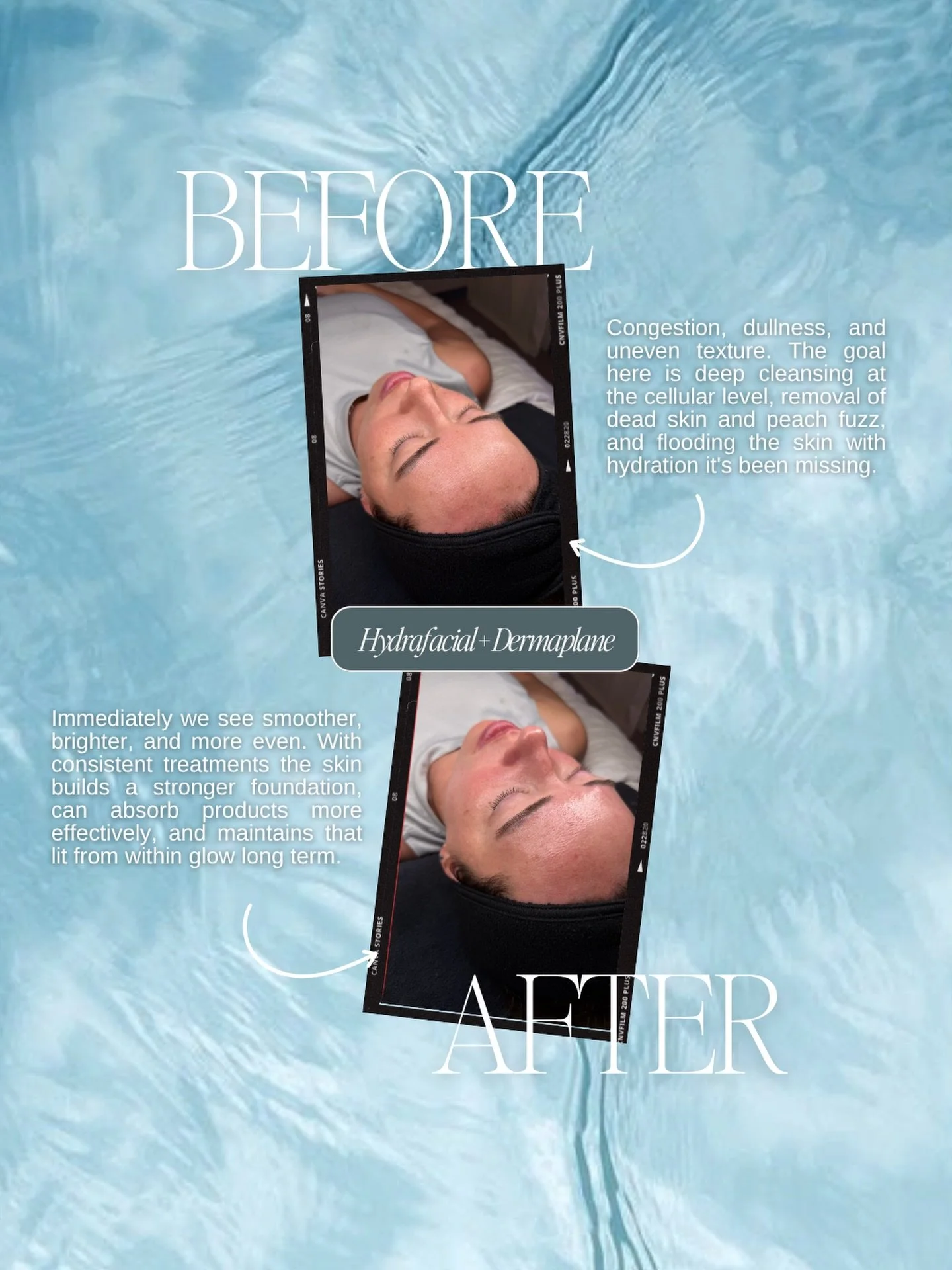 The HydraFacial and dermaplaning combo is the bread and butter of what we do at TRU and these results are exactly why. 🤍

Deep cleansing, hydration, and extractions paired with the removal of dead skin and peach fuzz for a smoothness and glow that y
