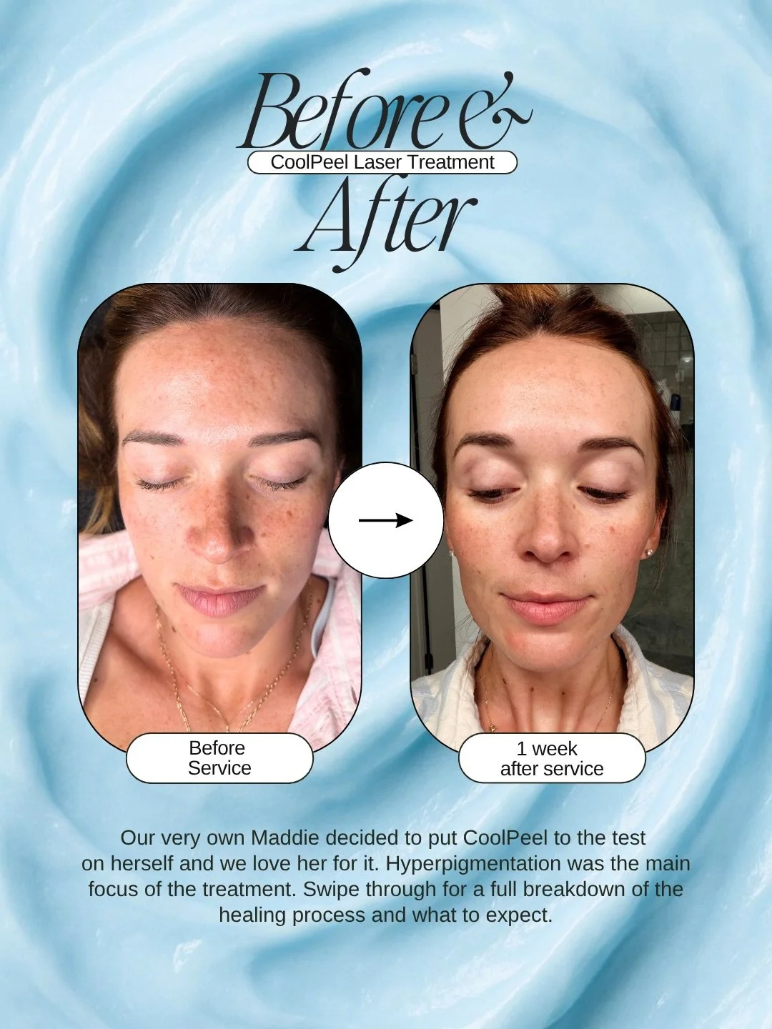 We promised you the results and here they are. 🤍

This is Maddie, our owner and founder, after just one CoolPeel treatment. Sun damage, hyperpigmentation, and uneven skin tone were the main concerns going in. Swipe through to see the full healing ti