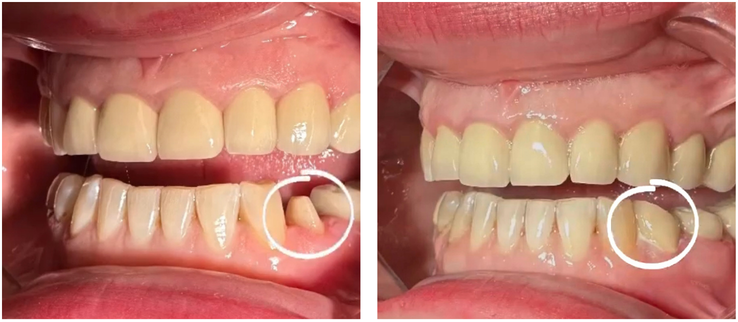 Comparison of teeth showing a chipped front tooth on the left and a repaired front tooth on the right.