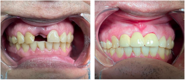 Comparison of teeth before and after dental treatment showing improved alignment and appearance.