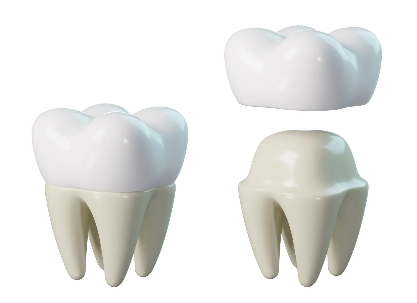 Two large 3D models of molar teeth, one with a white crown, the other with a cream-colored crown, demonstrating different stages of dental crown fitting or restoration.