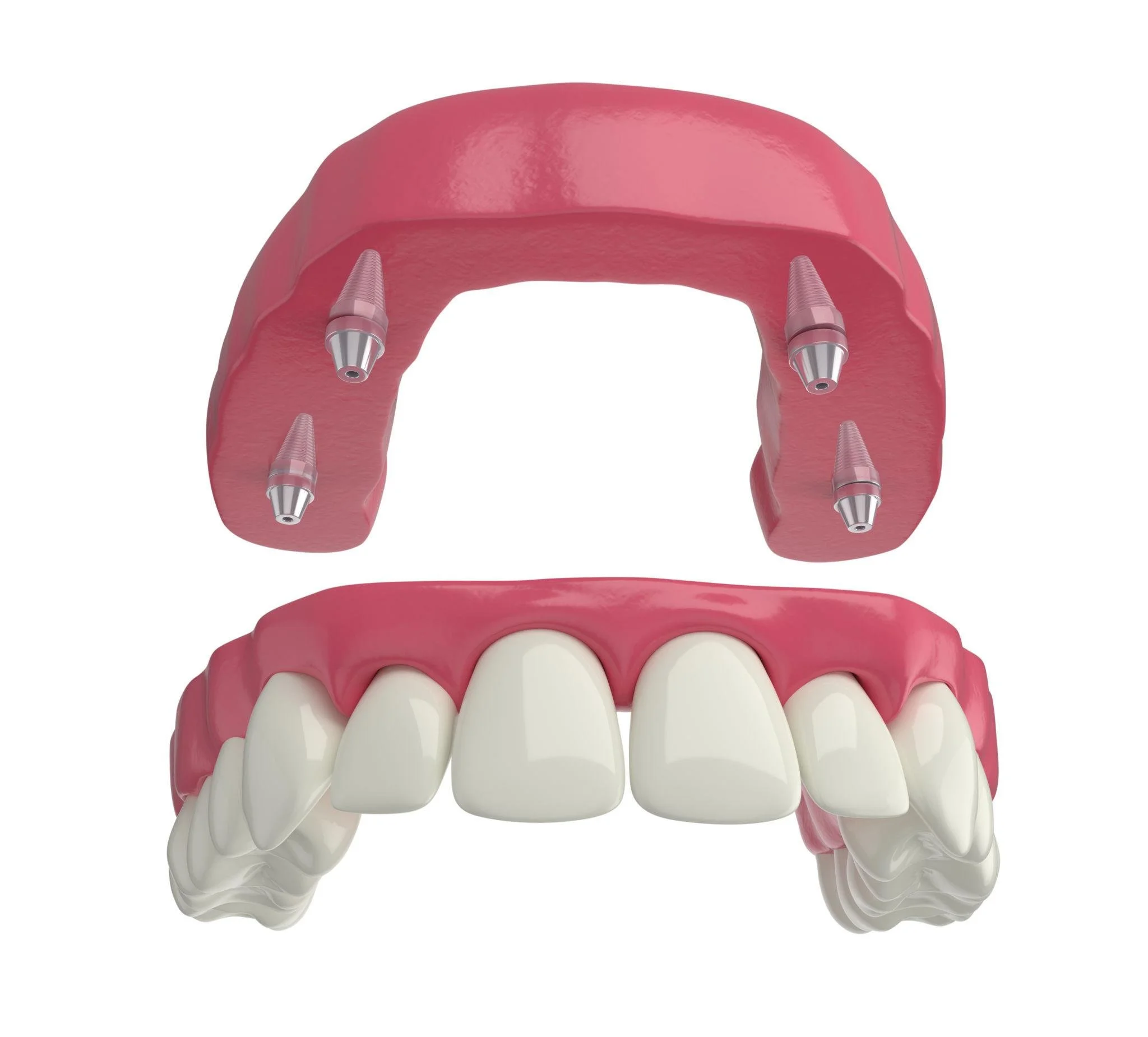 A digital illustration of a dental implant procedure showing a set of upper teeth, a pink gum model, and a pink upper jaw with four dental implants prepared for attachment.
