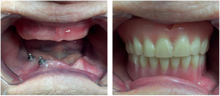 Close-up of dental implants on the lower jaw in the left image; upper and lower teeth, some discolored, in the right image.