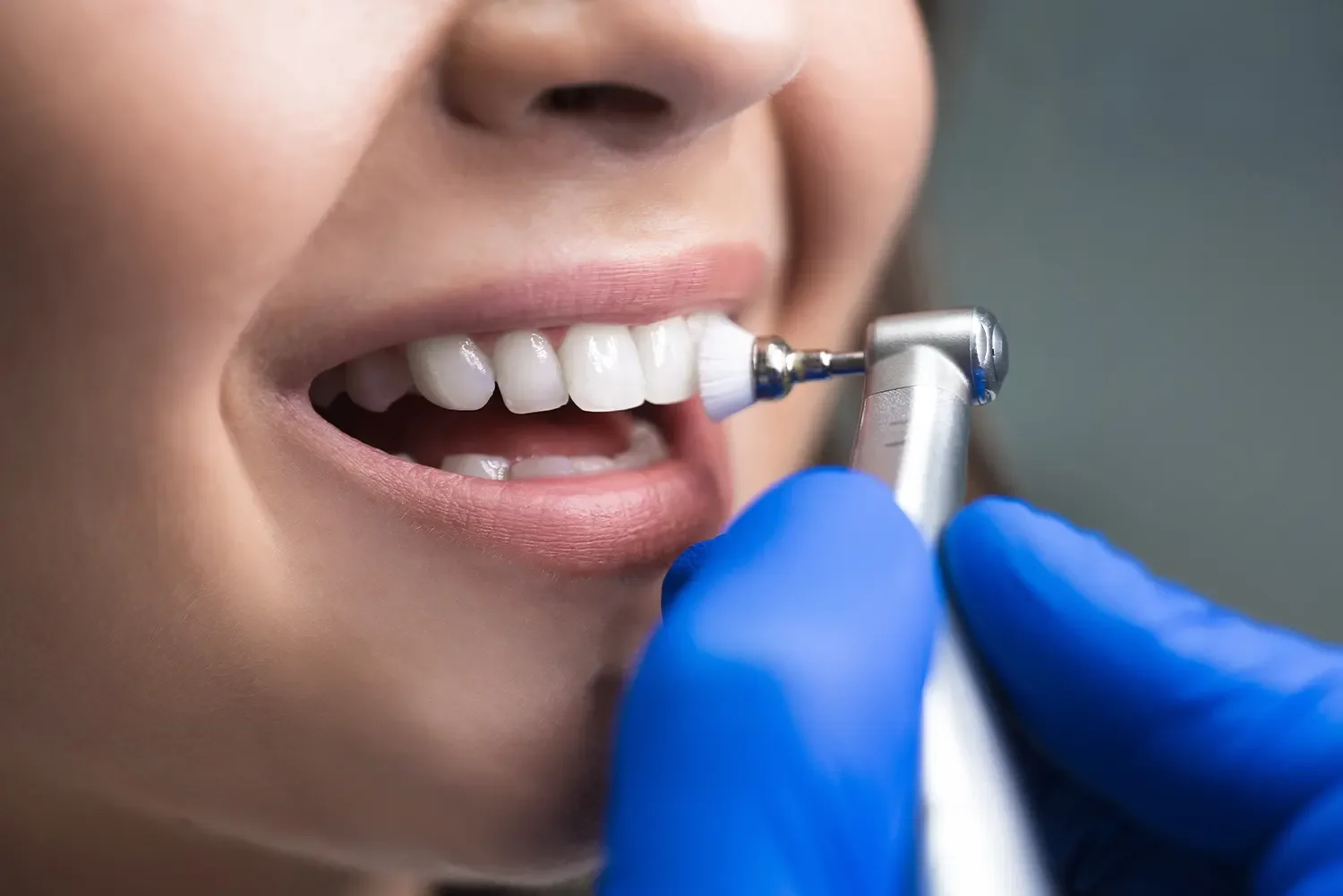 Close-up of a person receiving dental cleaning with a rotating brush tool in a dental office. The person has light skin and is opening their mouth, showing their teeth. A dental professional wearing blue gloves is holding the cleaning device.