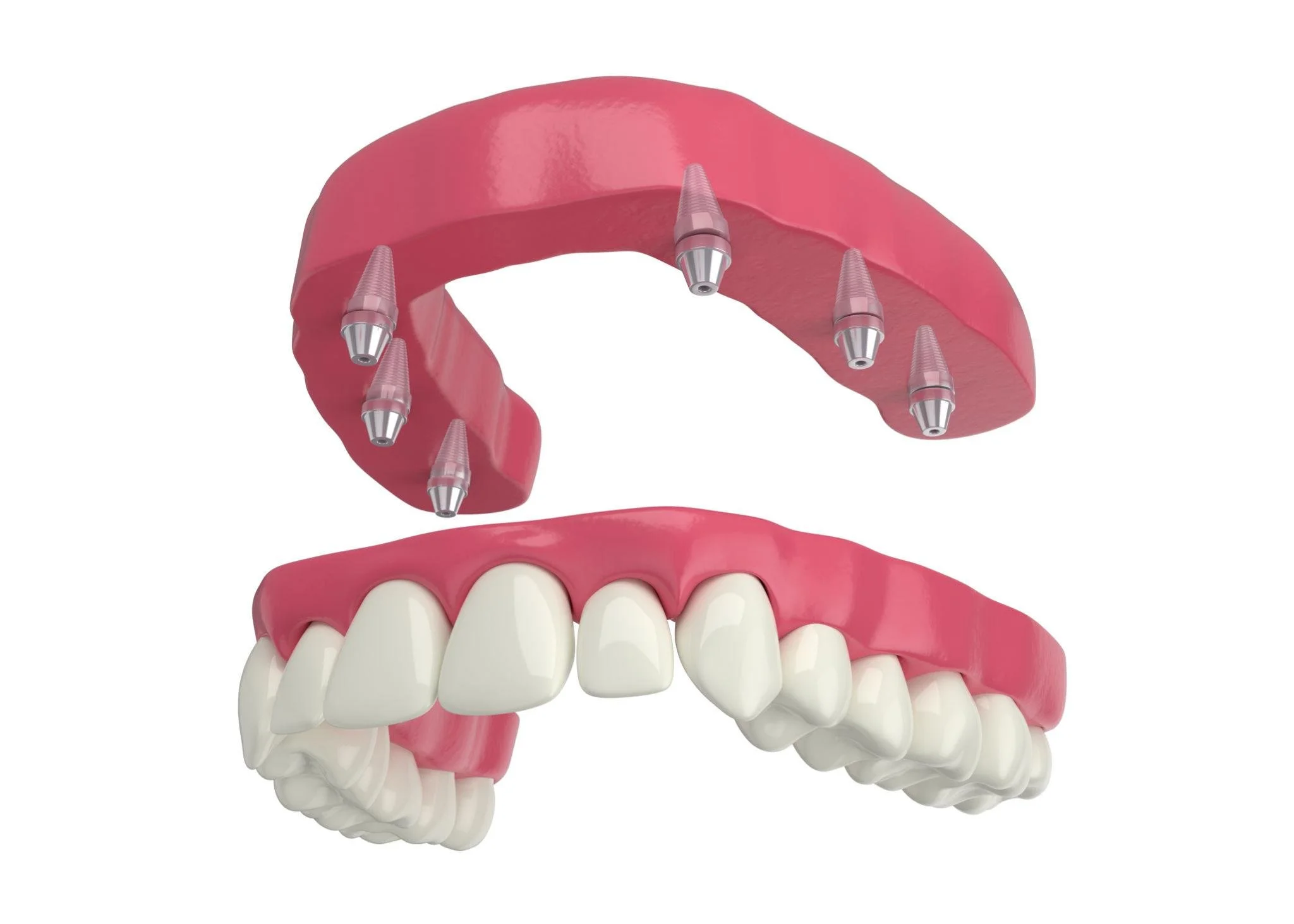 3D rendering of a dental implant surgical guide and a set of upper teeth with gums.