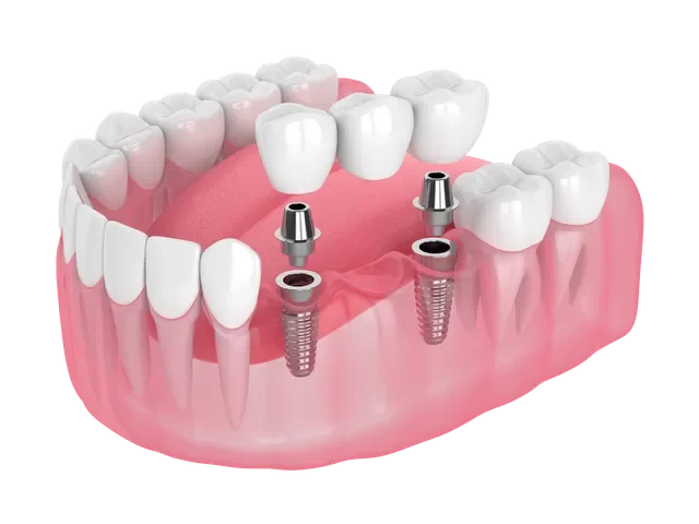 A dental model showing a dental implant procedure with two titanium screws, two abutments, and a crown in place.