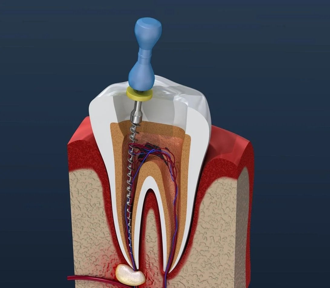 Cross-sectional illustration of a tooth undergoing root canal therapy with a dental drill and file inside the root canal.