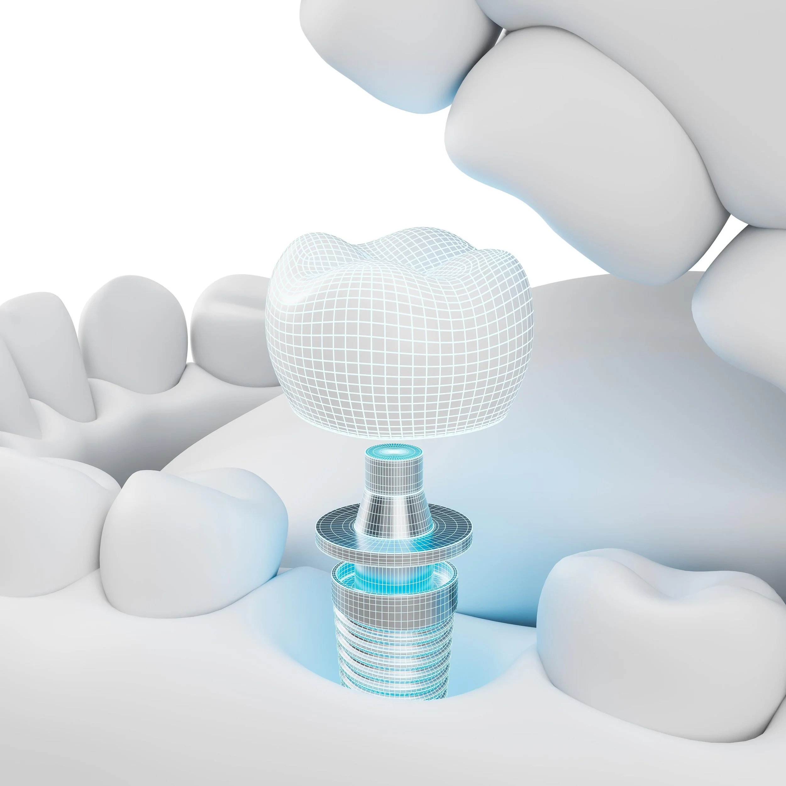 Digital rendering of a tooth being restored with a dental implant in a mouth with surrounding teeth.