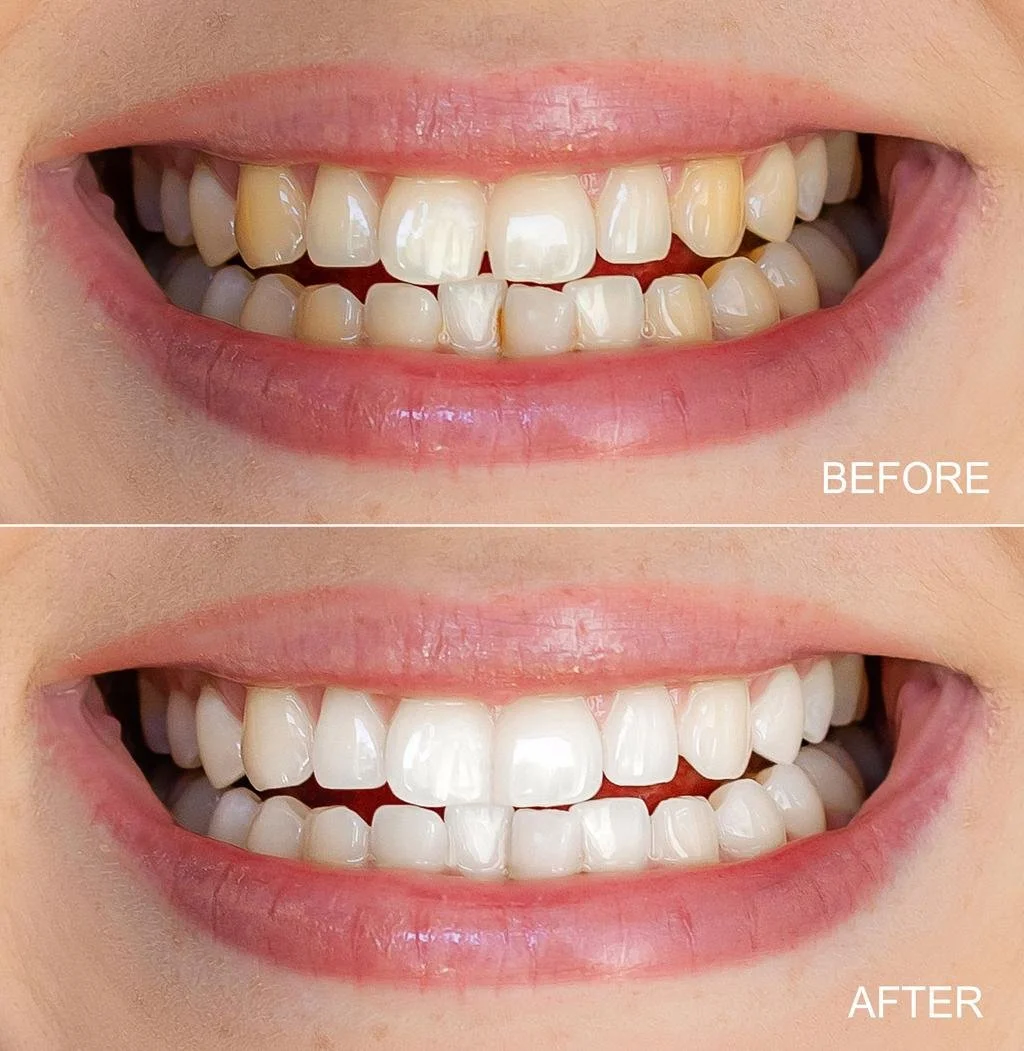 Close-up of a person's smiling mouth showing before and after dental whitening, with white, bright teeth in the after image.