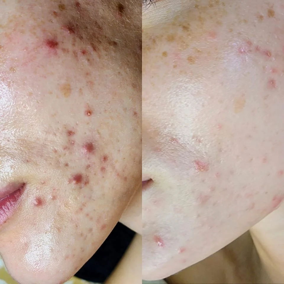 Sam's Acne Client cleared her skin using gentle, plant-based formulations for acne. By supporting the skin barrier, our esthetician was able to clear this client's skin in only 3 treatments.