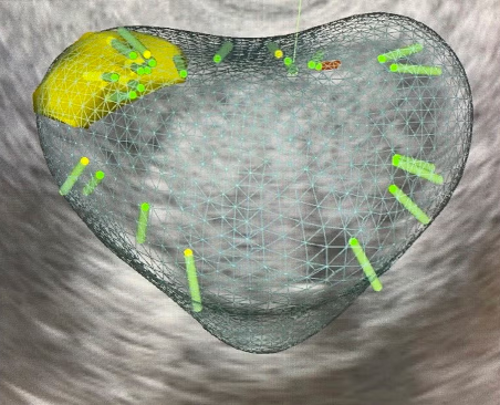 3D digital rendering of a heart with highlighted areas and measurements, overlaid on a grayscale ultrasound image.