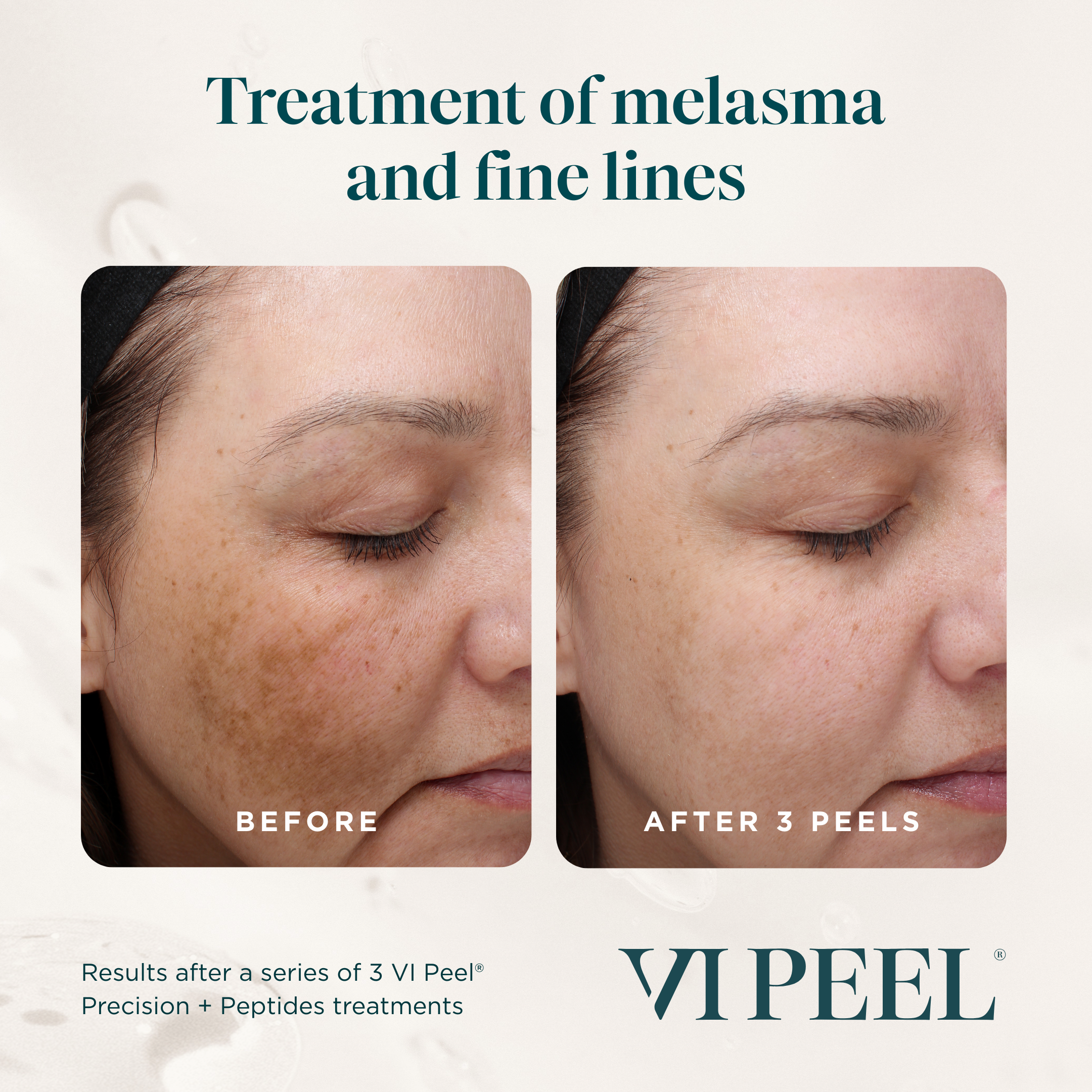 Before and after images showing the results of a skincare treatment for melasma and fine lines, with the text 'Treatment of melasma and fine lines,' 'Results after a series of 3 VI Peel Peerless+ Peptides treatments,' and 'After 3 peels'.