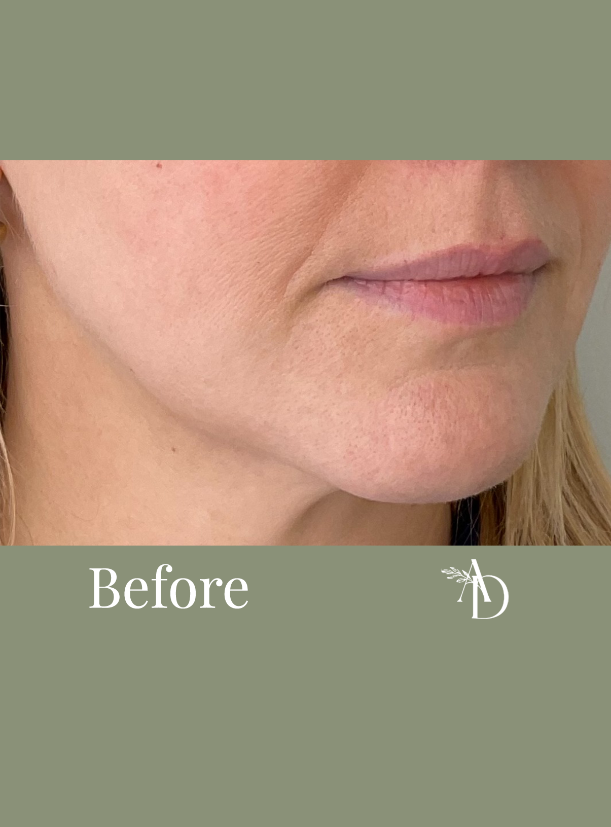Close-up of a woman's lower face showing skin texture and lips, with the word 'Before' at the bottom and a logo on the right.
