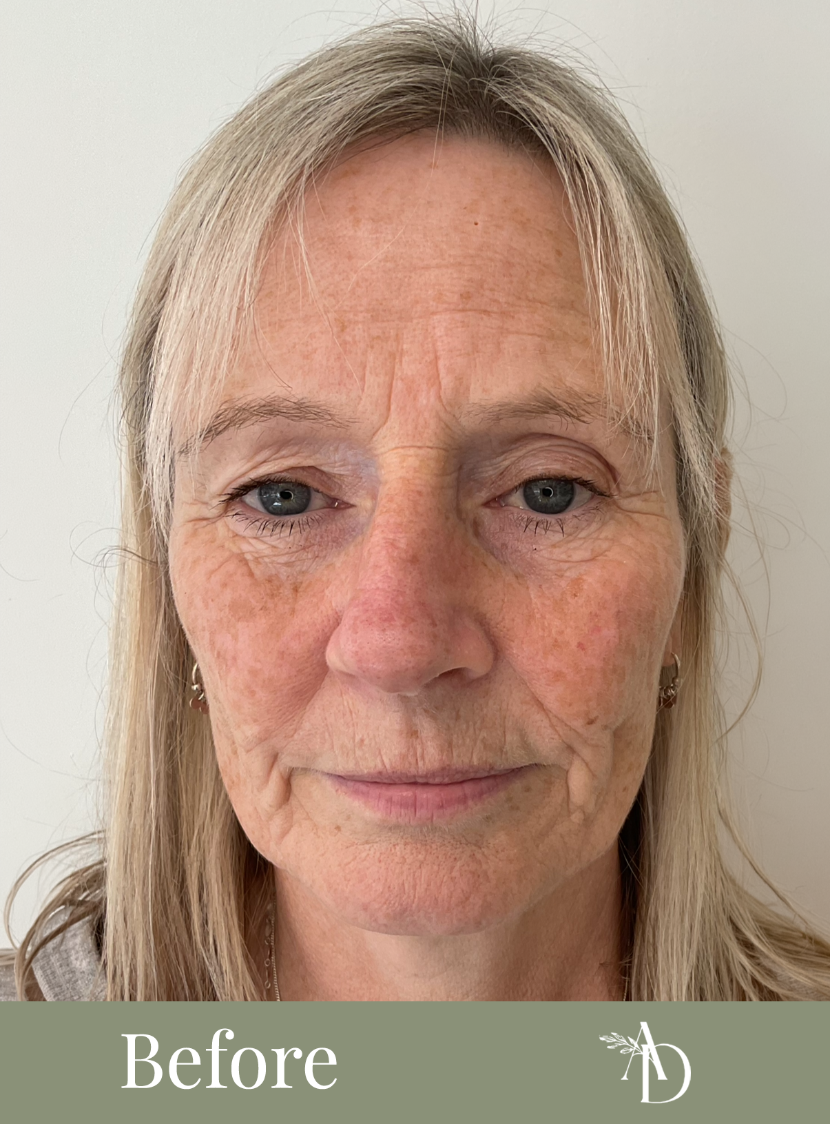 A close-up photo of a woman's face showing signs of aging, including wrinkles, fine lines, and uneven skin tone on her cheeks, forehead, and around her eyes, with a neutral expression and slightly tired eyes.