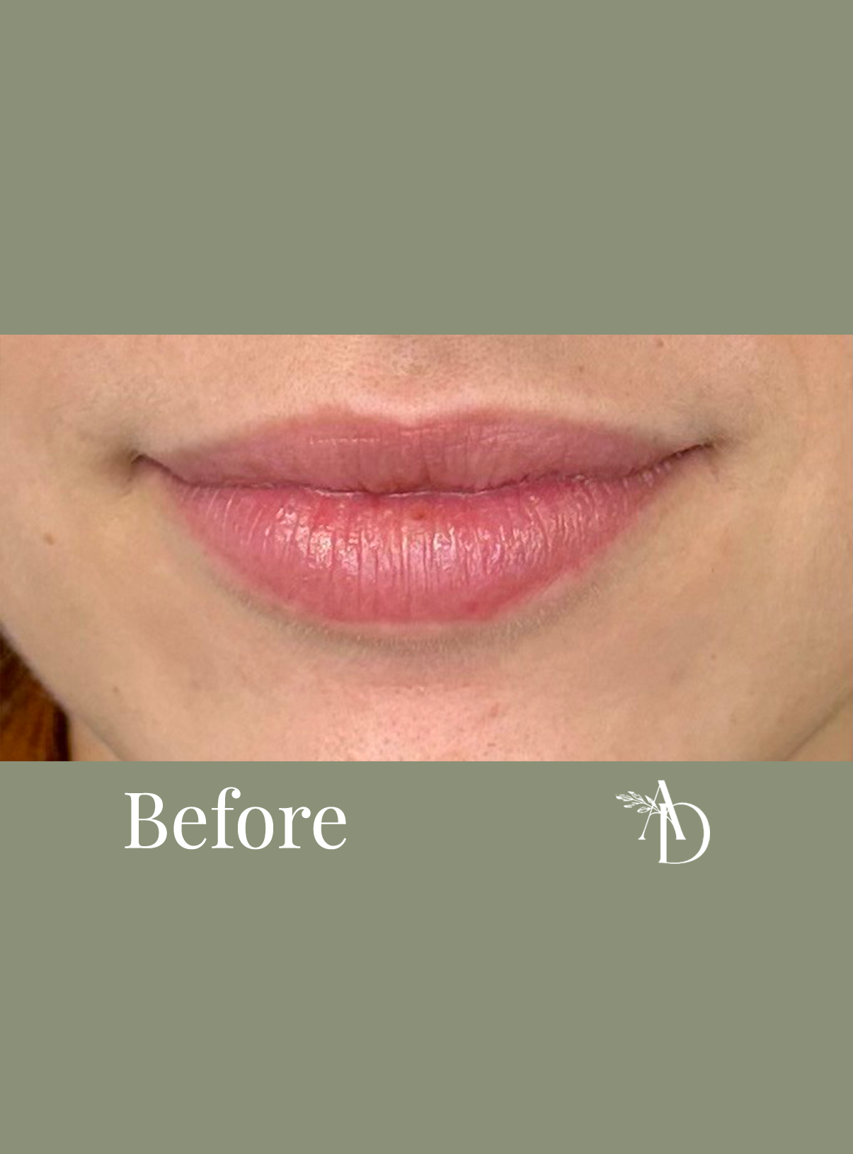 Close-up of a person's lips, showing natural pink color, with the word 'Before' at the bottom of the image. The image appears to be part of a comparison or transformation series.