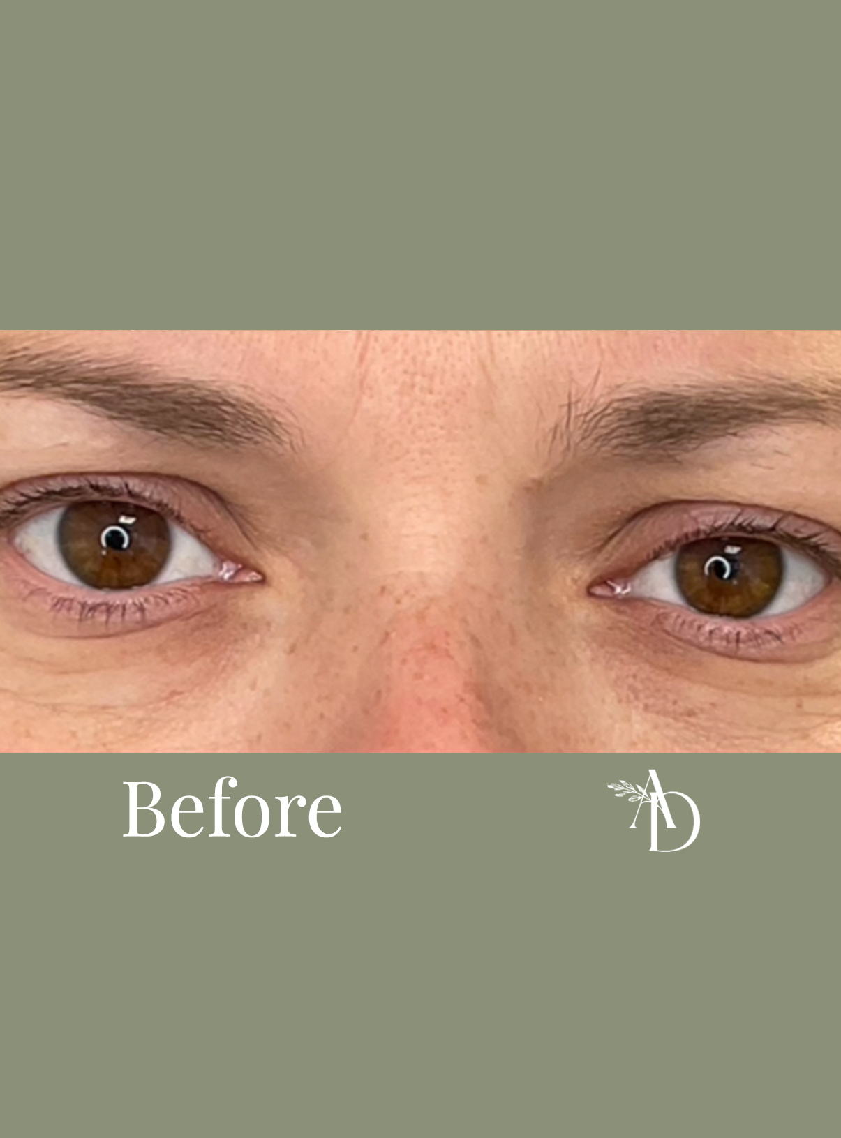 Close-up of a person's brown eyes and eyebrows, with the word 'Before' written at the bottom. The image shows natural skin and minimal makeup.