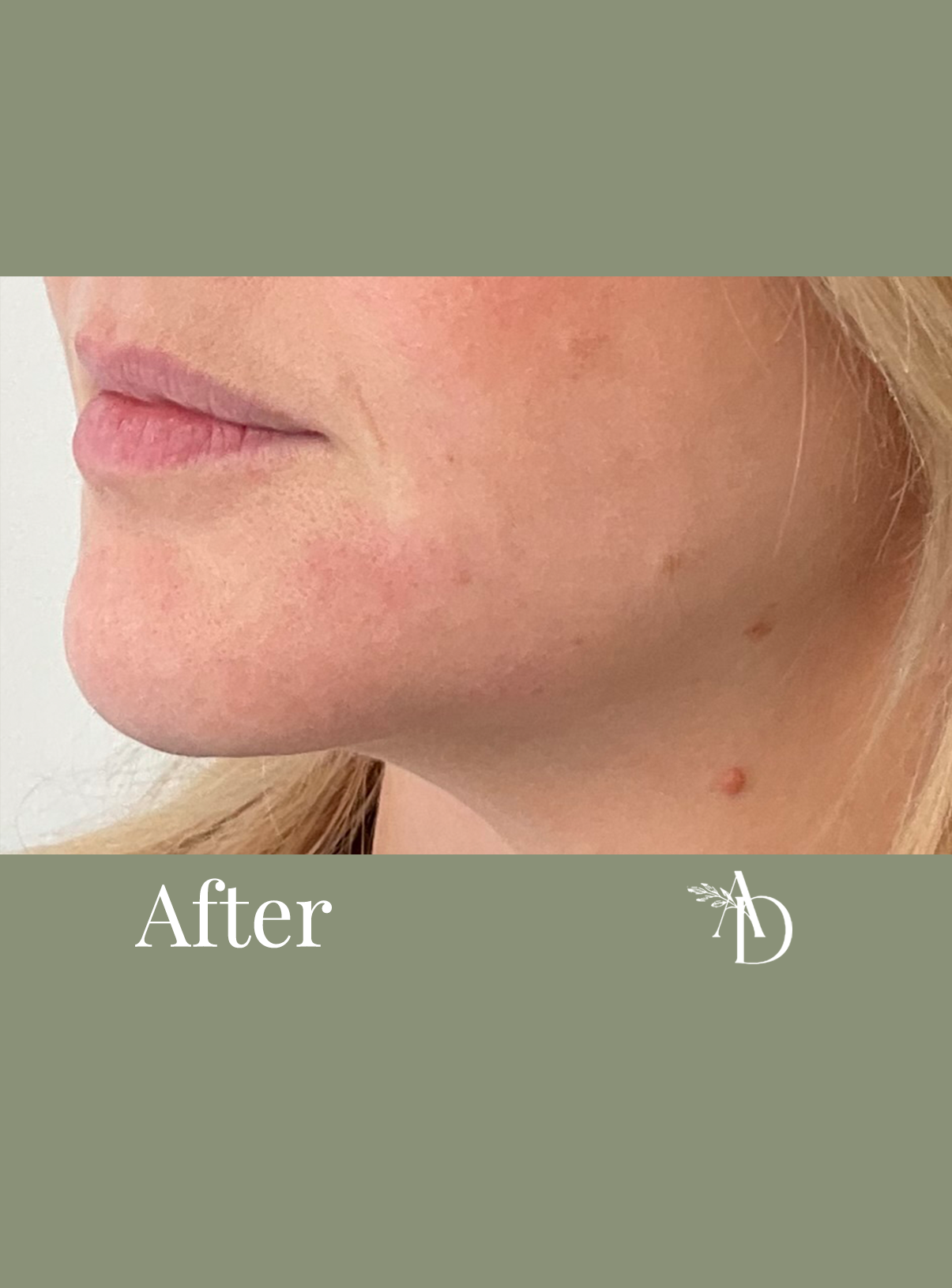 Close-up of a woman's lower face and neck showing skin improvements, with the word 'After' on a muted green background.