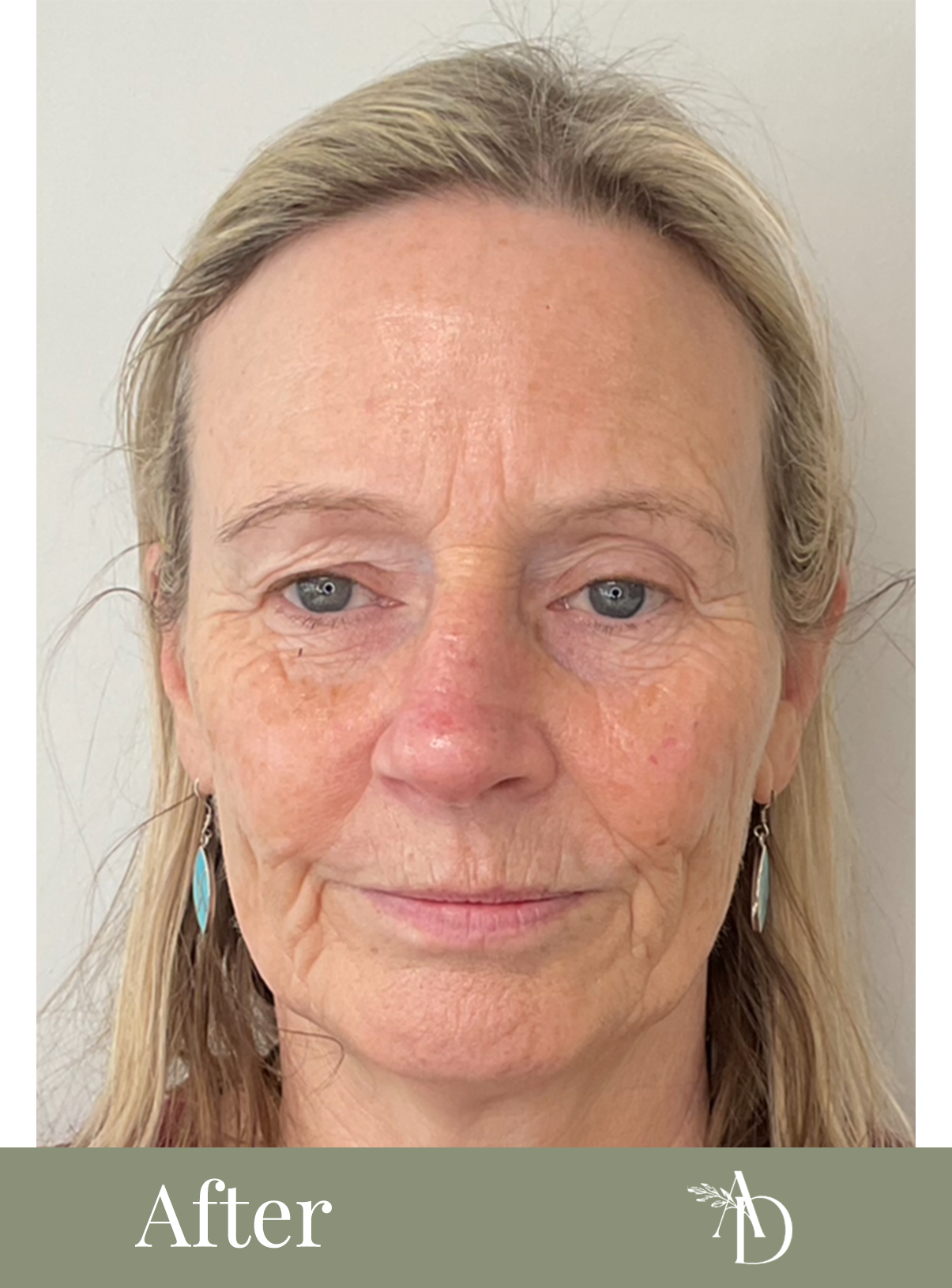 Close-up photo of an older woman with blonde hair, blue eyes, and earrings, showing her face with visible signs of aging.