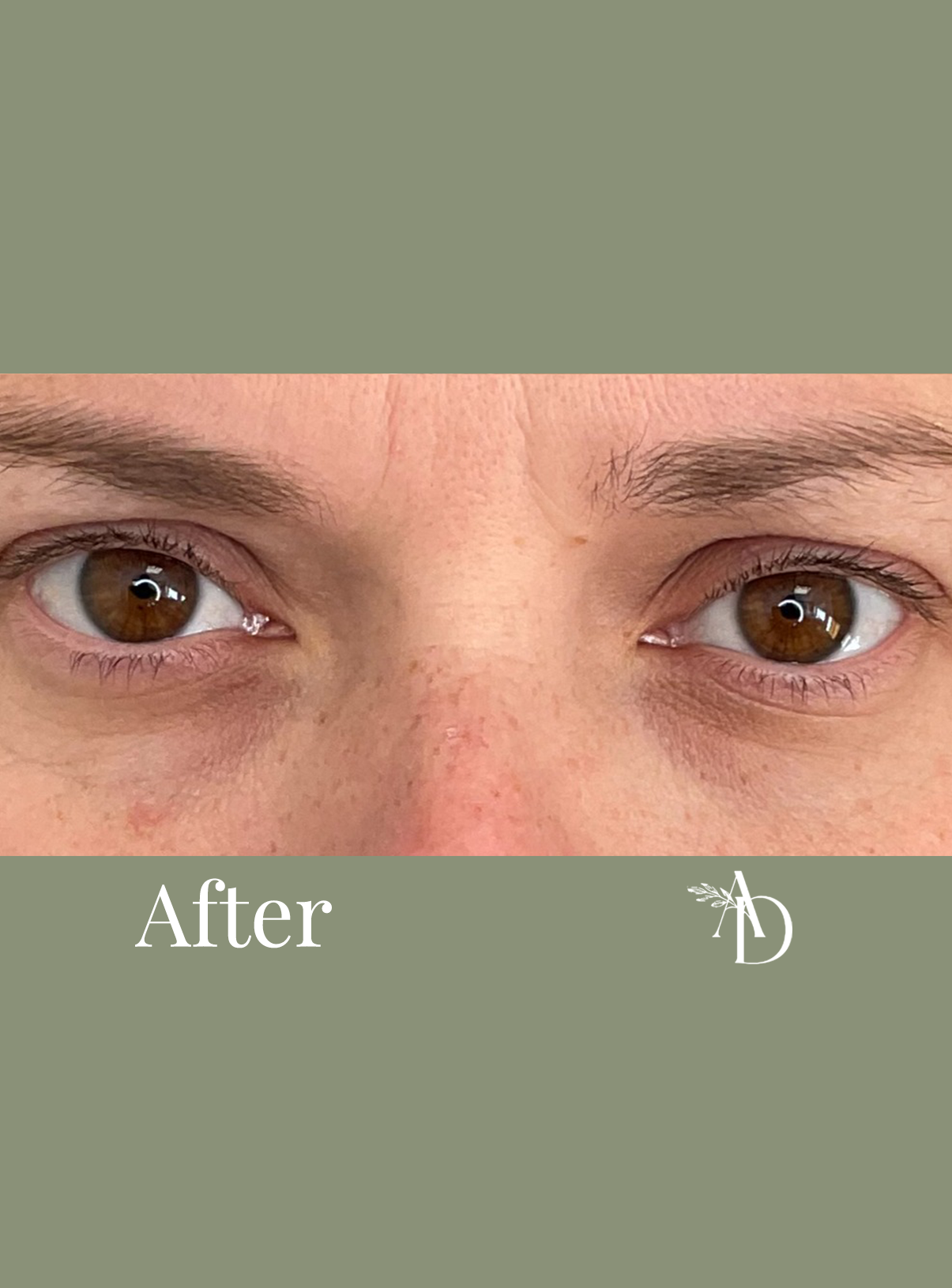Close-up of a person's brown eyes and forehead, labeled 'After' on a green background.
