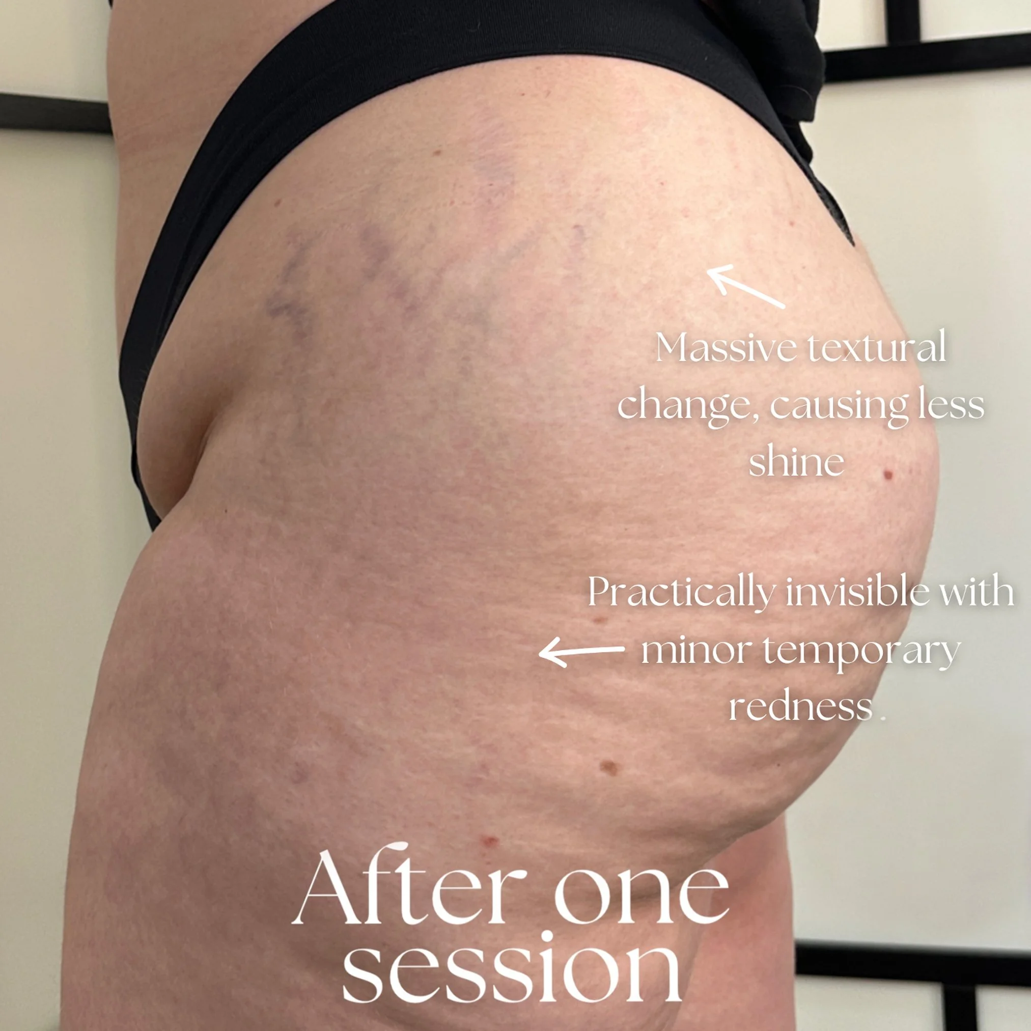 inkless stretch mark revision ISR after one session, with annotations indicating a massive textural change causing less shine and minor temporary redness that is practically invisible.