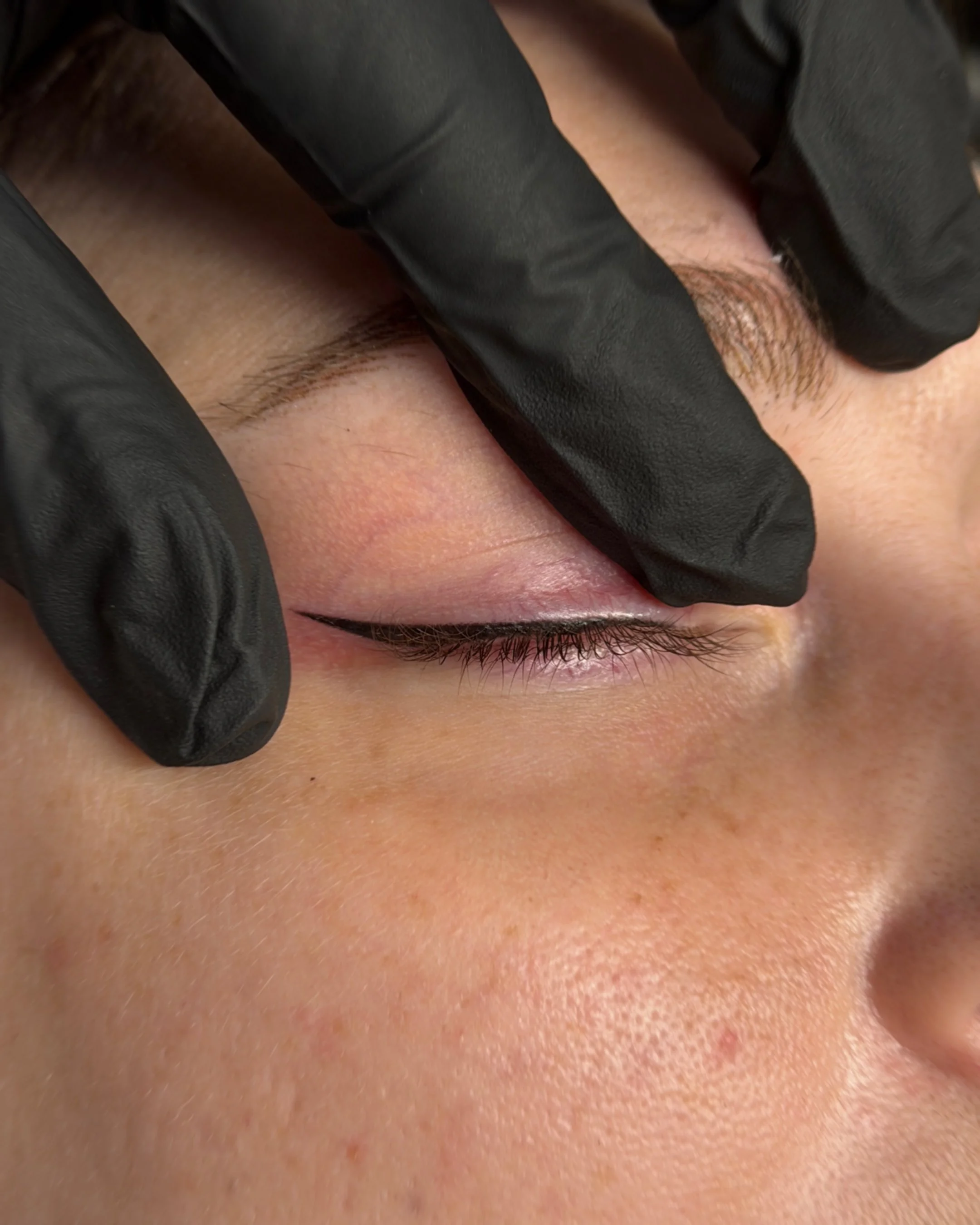 A person with fresh eyeliner tattoo, with a gloved hand gently pulling the eyelid for precise work.