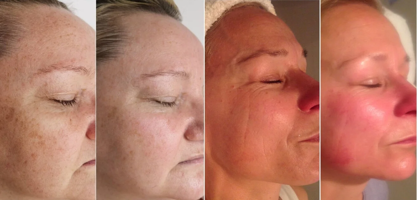 Four side-by-side images showing a woman's face before and after skincare treatment, focusing on reduction of freckles and skin redness.