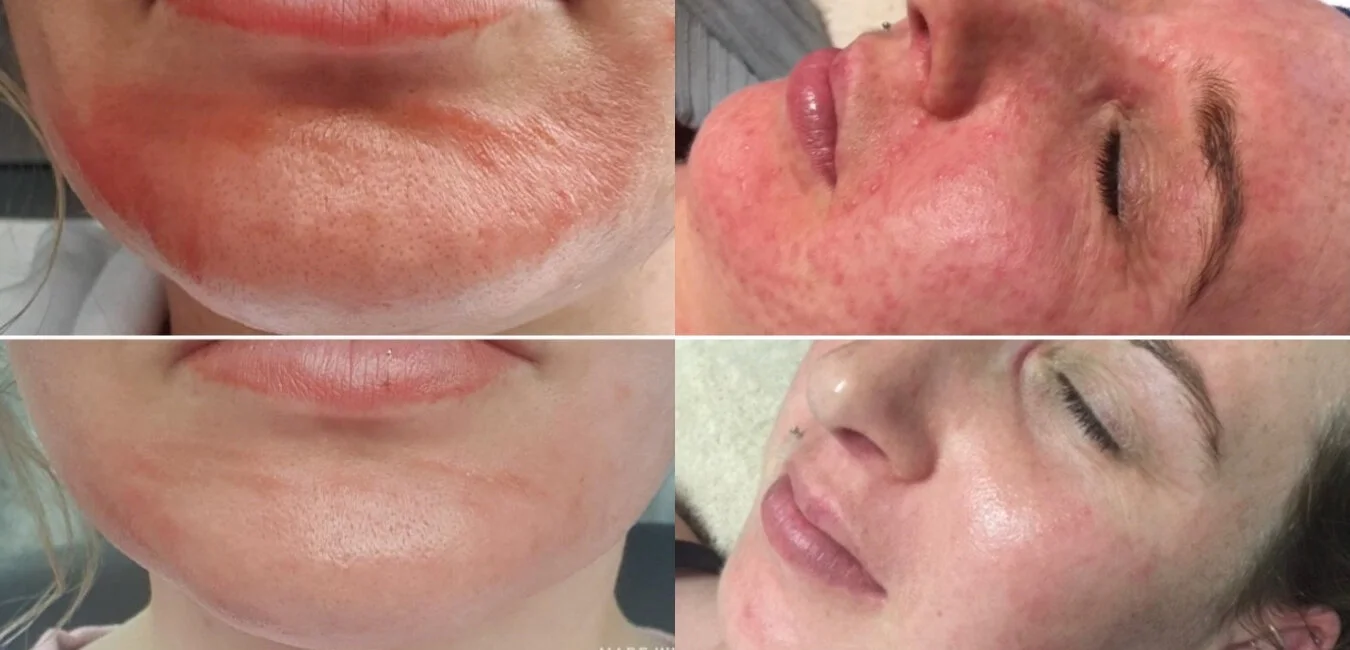 Before and after images of facial skin improvement showing reduction in pore size, redness, and skin texture.