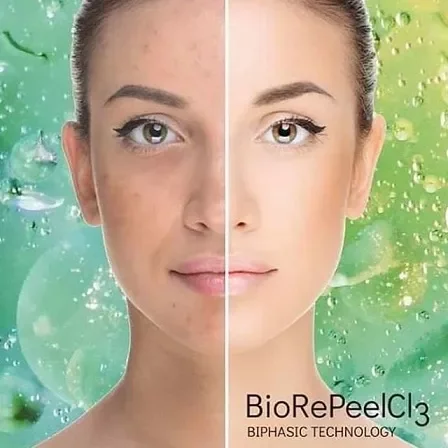 A side-by-side comparison of a woman's face showing skin with acne on the left and clear skin on the right, with a green background and water droplets, promoting BioRePeel C3 biostatic technology.