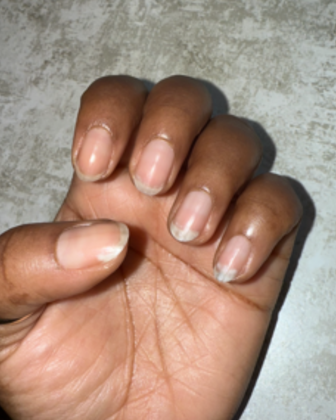 What Causes Weakness in Nails?