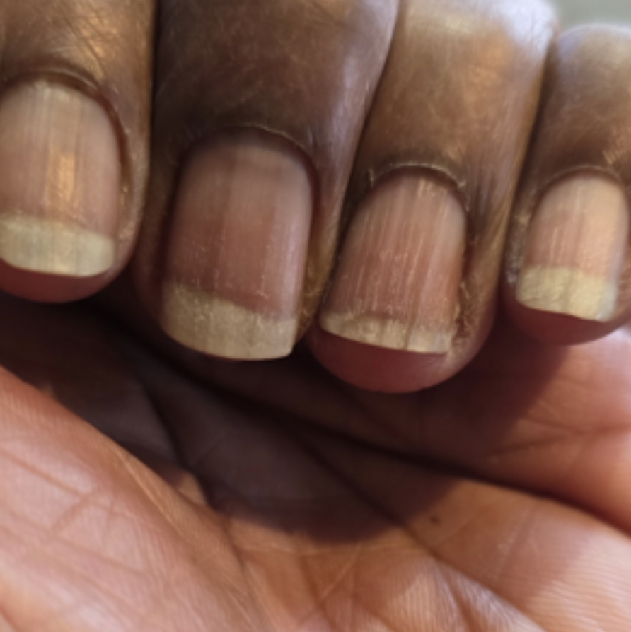 Dry peeling nails nyc