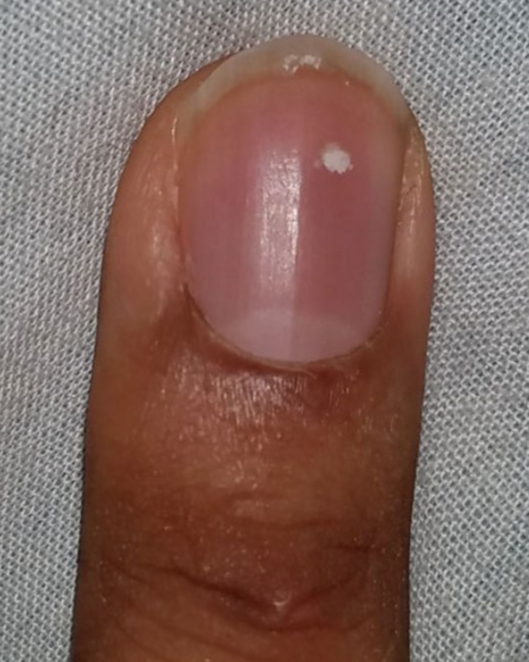 white spots on the surface of the nails
