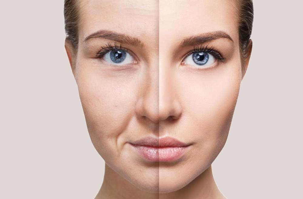 Harmonização Facial (Preenchimentos)