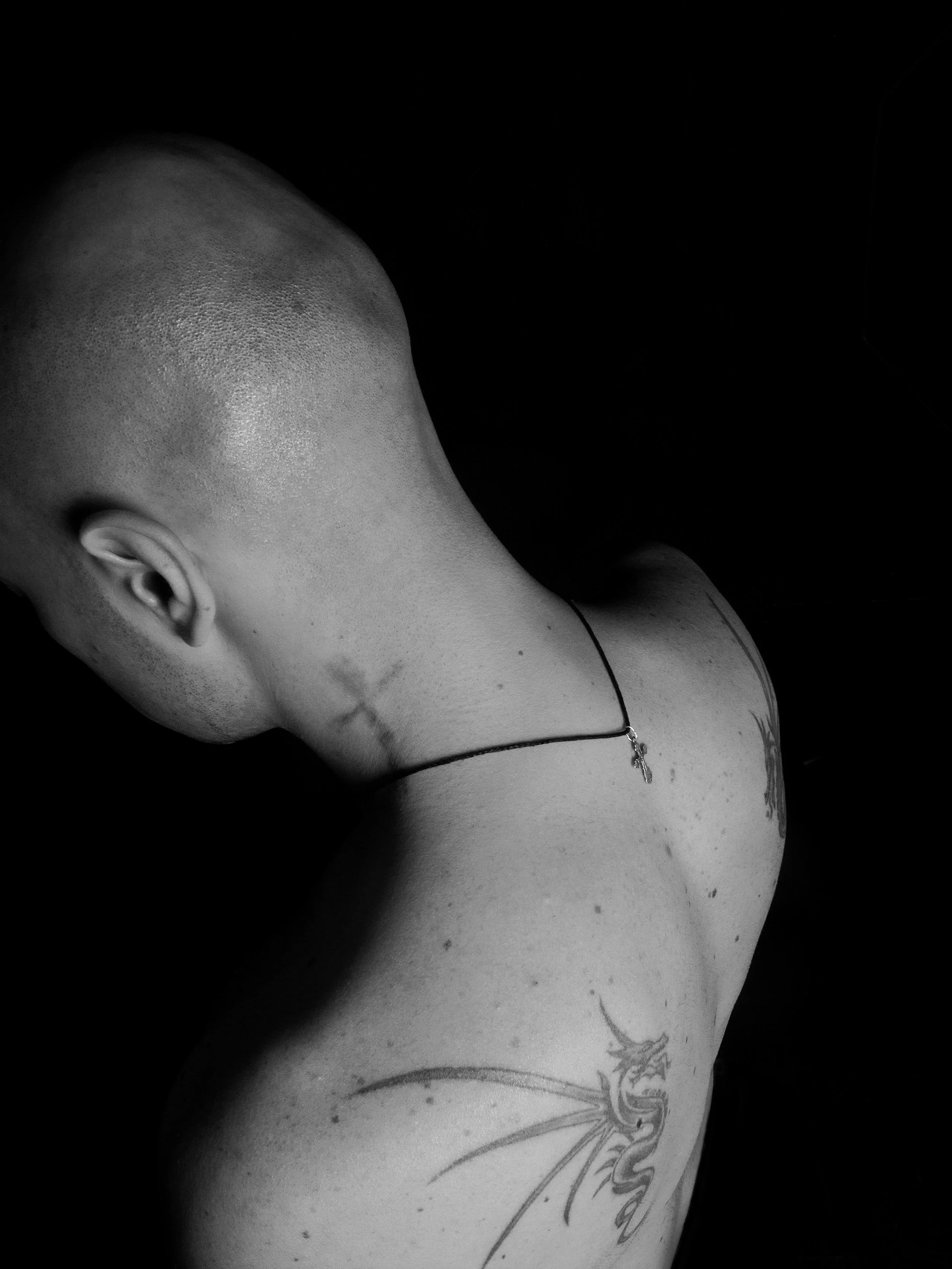 DOES TATTOO REMOVAL HURT?