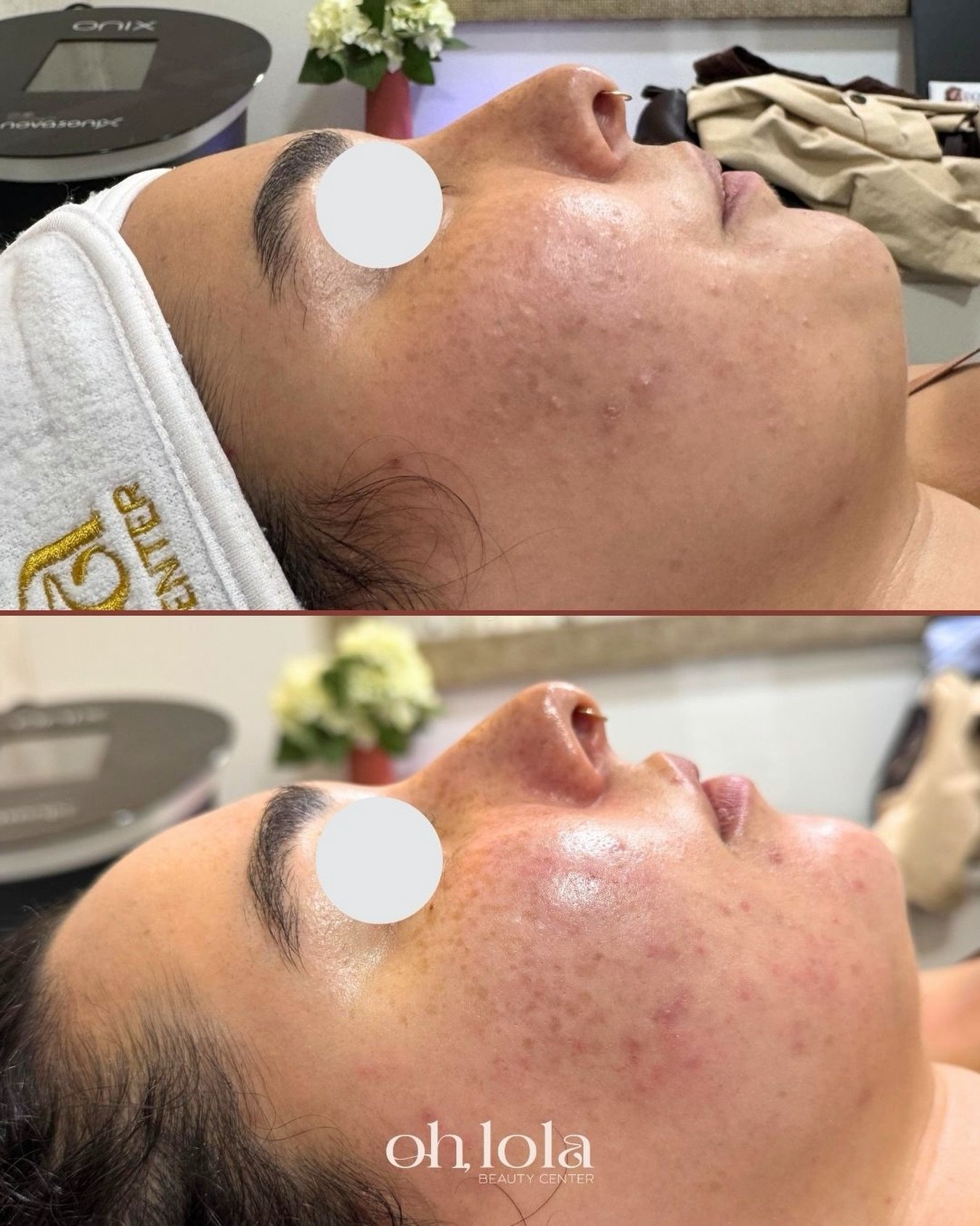 &iquest;Cu&aacute;nto puede cambiar tu piel en una sola cita? 🤍

Adi&oacute;s a la piel congestionada, comedones cerrados y falta de luminosidad. Con el protocolo adecuado: limpieza profunda, poros libres y luminosidad real. Esto no es magia, es con