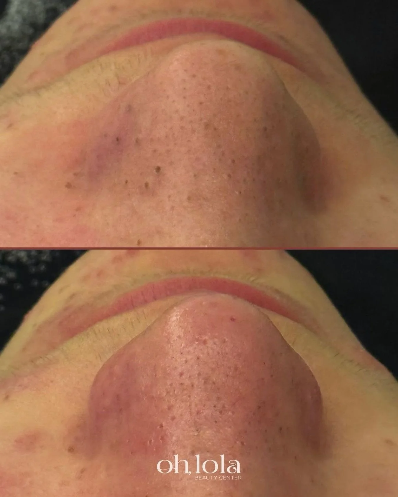 La adolescencia es una &eacute;poca complicada para la piel. Ayudarla desde el principio marca la diferencia a largo plazo. 

Esto es lo que puede cambiar una piel joven con los poros saturados despu&eacute;s  de una limpieza facial. 🙌🏼

Ayudal@ a 