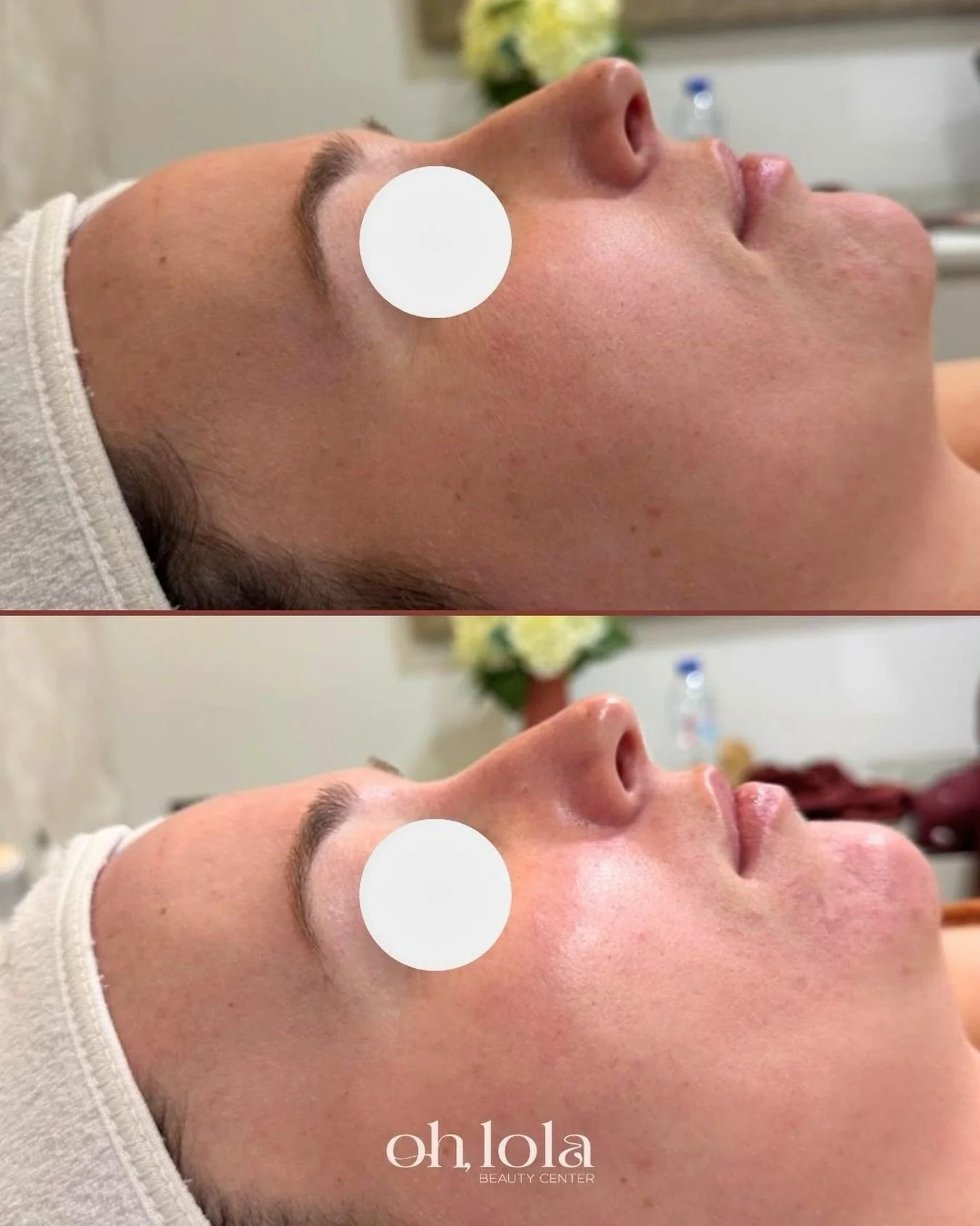 Tu piel cambia cuando empiezas a cuidarla de verdad.
Ese glow no viene de un filtro, viene de una piel hidratada, luminosa y tratada correctamente ✨

En Oh Lola trabajamos para que tu piel se vea fresca, sana y con luz propia desde la primera sesi&oa