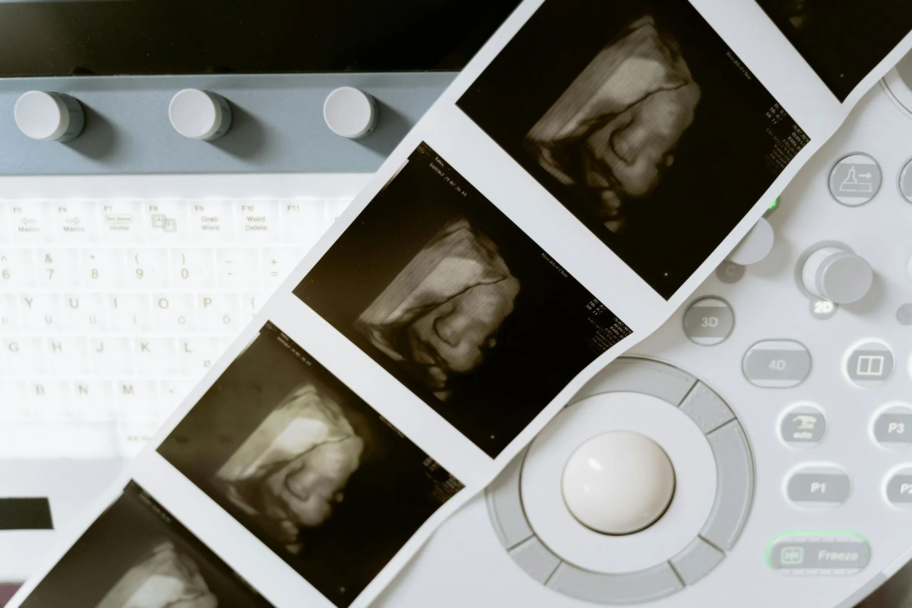 Early Pregnancy Scan
