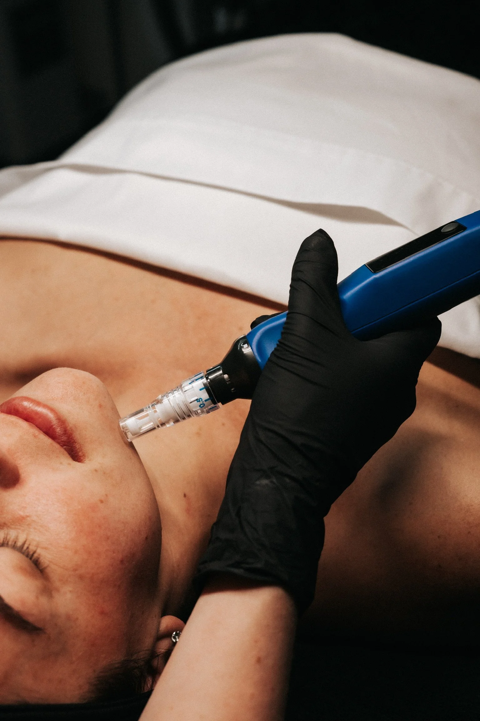 microneedling centennial